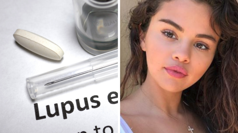 Lupus: la enfermedad autoinmune que afecta principalmente a mujeres