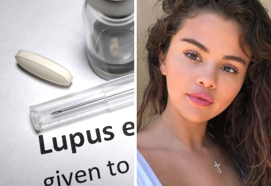 Imagen que dice lupus y al lado una imagen de Selena Gómez