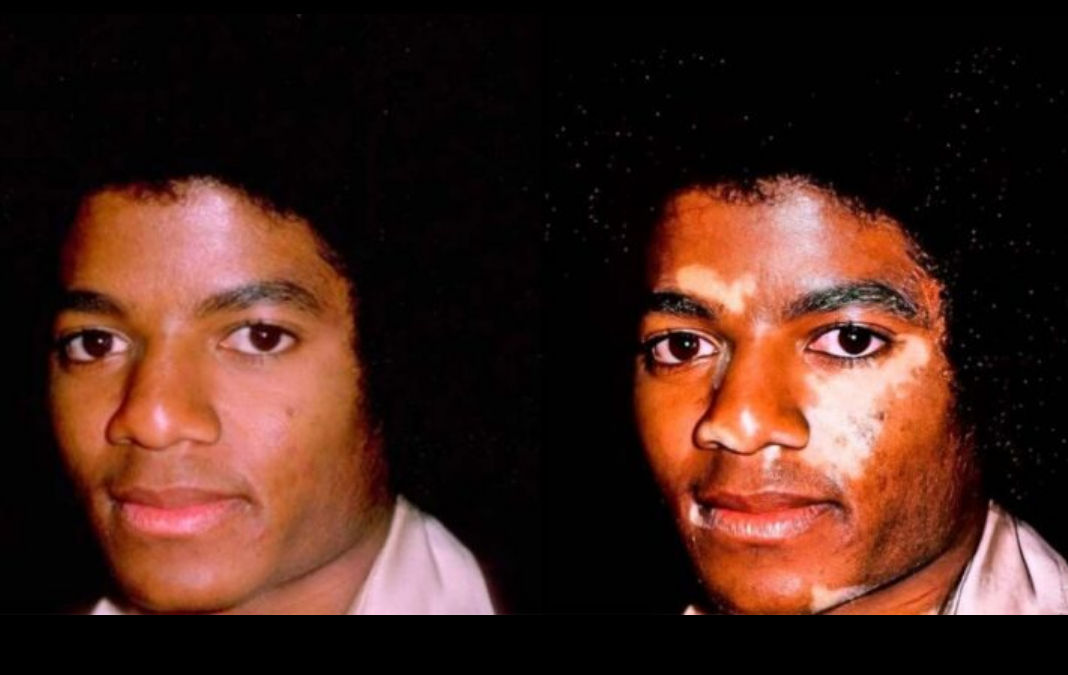 Michael Jackson con vitiligo