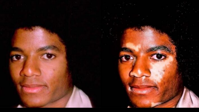 Michael Jackson con vitiligo