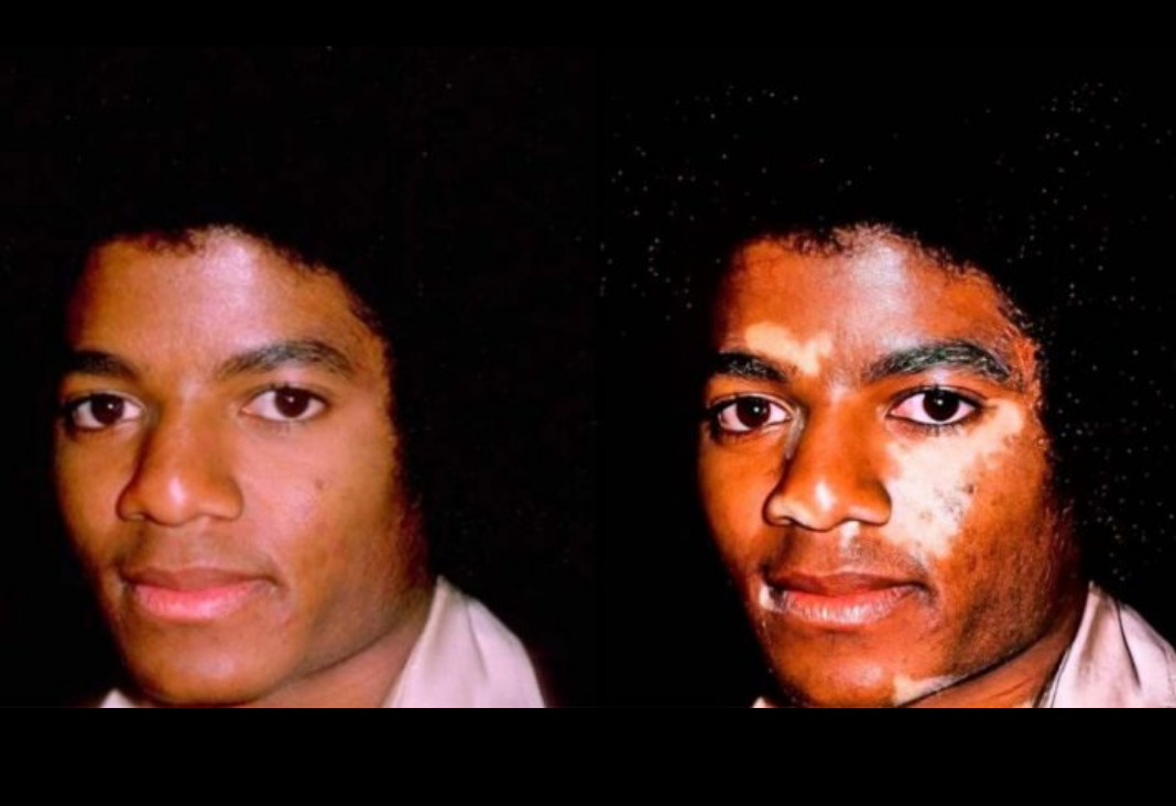 Michael Jackson con vitiligo